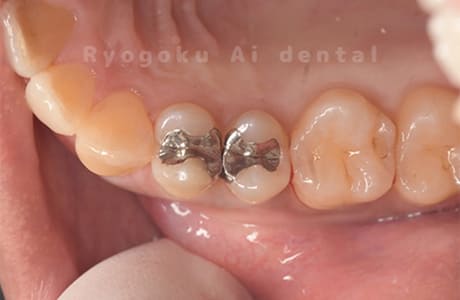 インレー２次カリエス