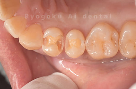 ダイレクトボンディング、セラミックインレー修復術中