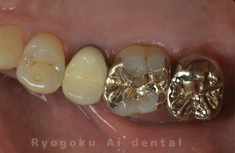 ゴールドインレー、ゴールドクラウン術後
