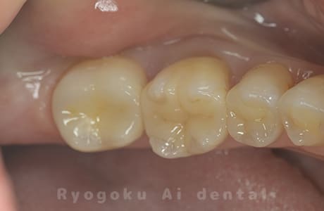 セラミックインレー修復