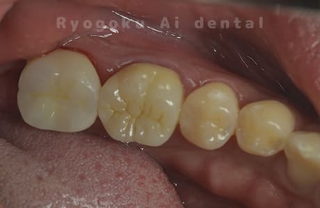 ジルコニアクラウン治療