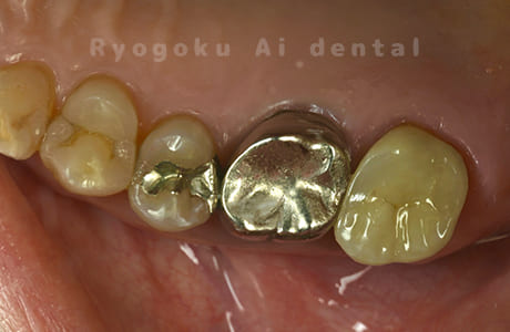 ジルコニアクラウン