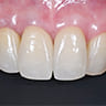 前歯のセラミック補綴治療