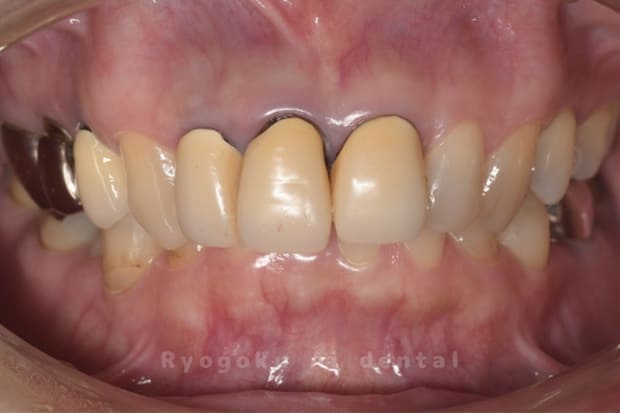 前歯部前装冠不適合、重度２次カリエス