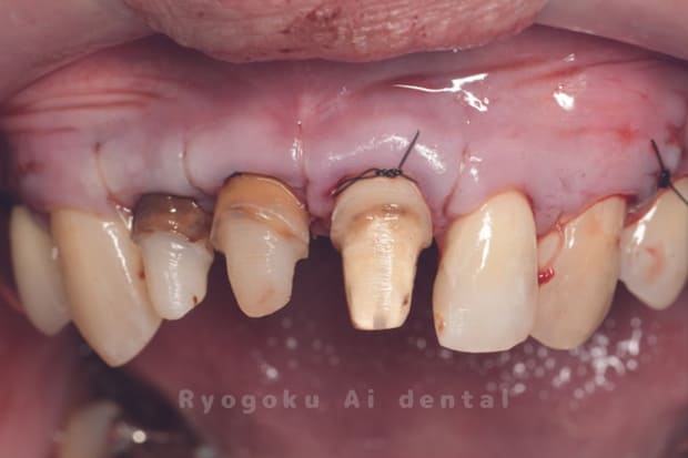 クラウンレングスニング術中