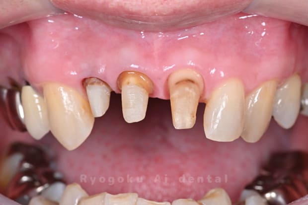 クラウンレングスニング術後