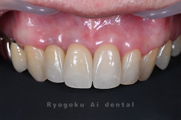 ジルコニアセラミック修復