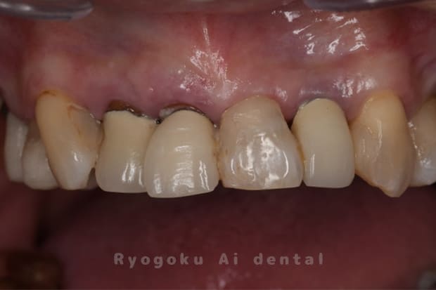 右上１番歯牙破折