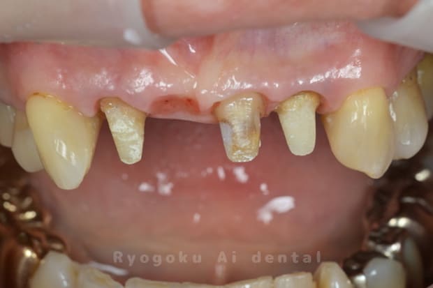 ソケットプリザベーション