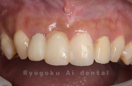 前歯部補綴不適合
