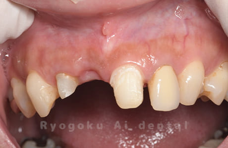 前歯部補綴除去