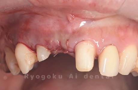 リッジオーギュメンテーション術後