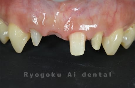 ジルコニアセラミックブリッジ術後