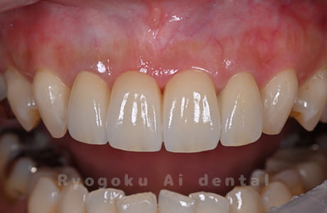 ジルコニアセラミックブリッジ修復
