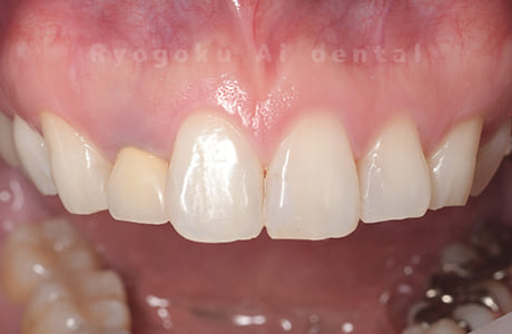 レジン前装冠不適