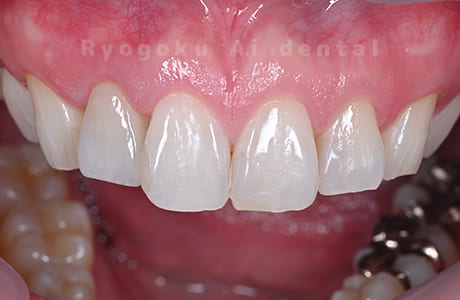 ジルコニアセラミッククラウン治療