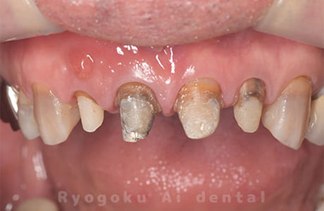 ダイレクトボンディング、セラミックインレー修復術中