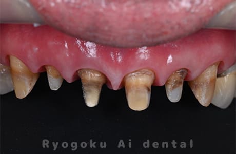 ダイレクトボンディング、セラミックインレー修復術中