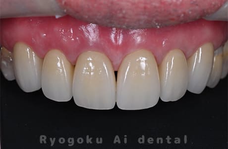 ダイレクトボンディング、セラミックインレー修復術後
