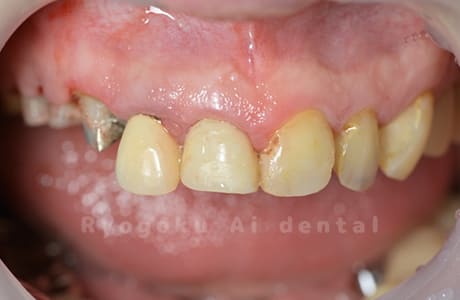 重度カリエス、前歯部被せ物脱離