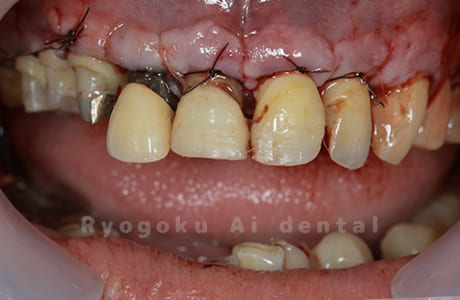 クラウンレングスニング術中