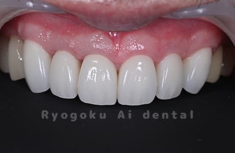 前歯部ジルコニアセラミッククラウン修復、クラウンレングスニング