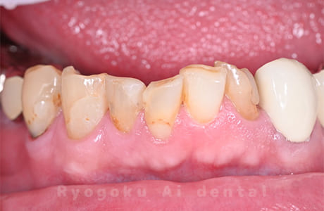 下顎前歯部重度カリエス