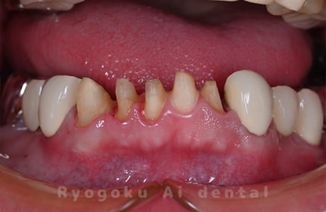 クラウンレングスニング術中