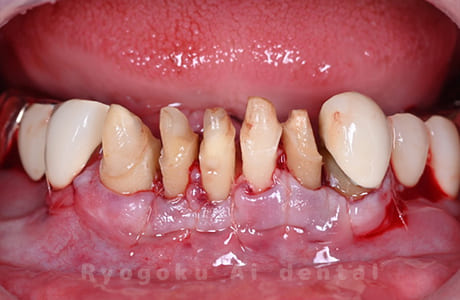 クラウンレングスニング術後