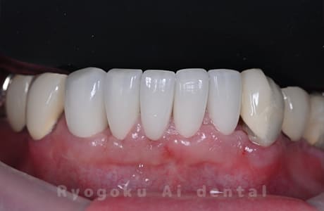 前歯部ジルコニアセラミッククラウン修復、クラウンレングスニング