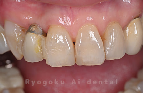 前歯を治したい