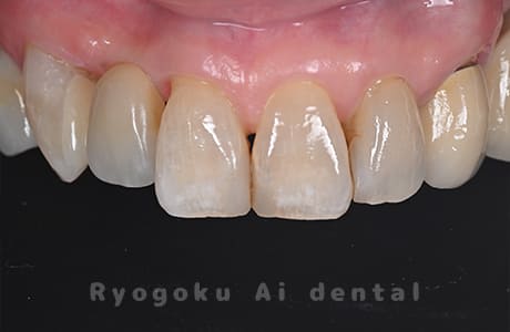 右上2番接着性ブリッジ