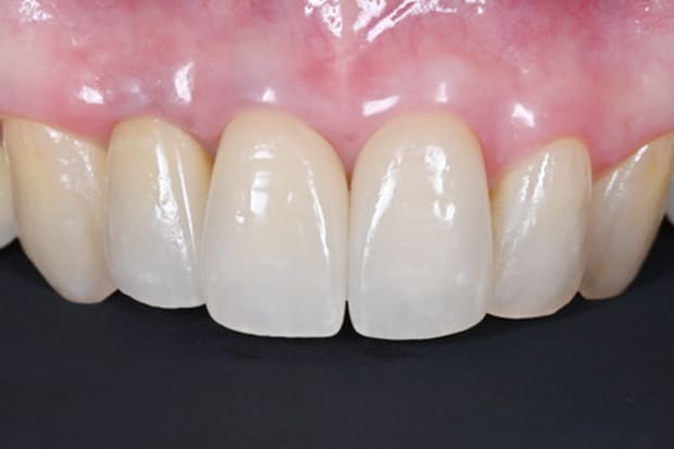 笑顔を取り戻す前歯のセラミック治療