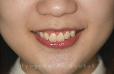 ガミースマイル改善治療術後正面