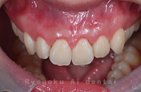 ガミースマイル改善治療術後口腔内