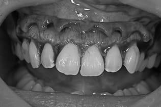 ガミースマイル改善治療手術２