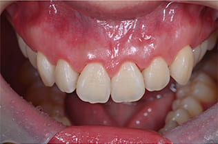 ガミースマイル改善治療術後２