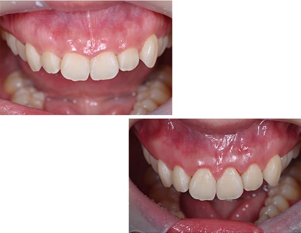 歯根端切除術とは