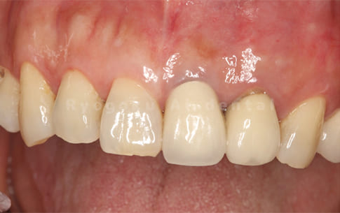 左上2番、歯の破折