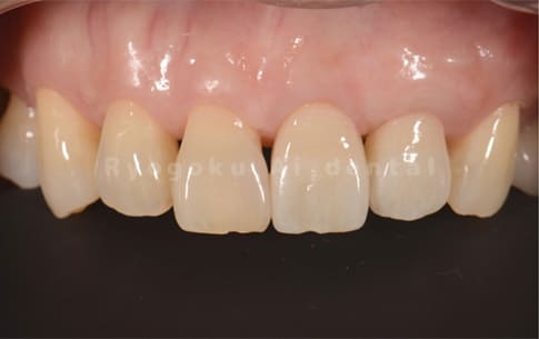 左上2番インプラント治療
