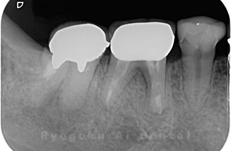 歯牙破折のレントゲン