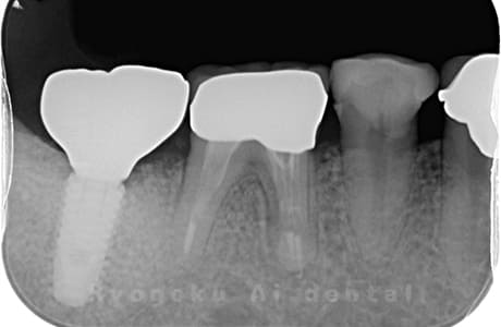 インプラント治療後のレントゲン