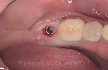 インプラント埋入後