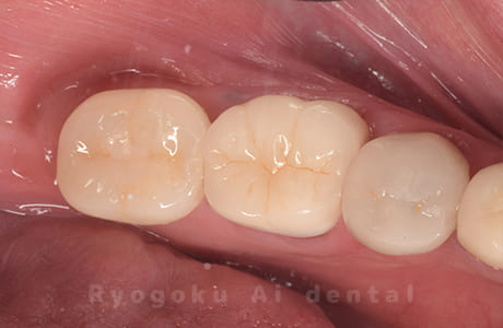 インプラント治療完了