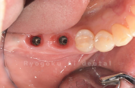 インプラント埋入後