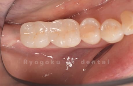 インプラント治療完了