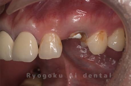 左上犬歯パーフォレーション