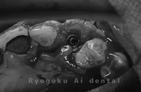 インプラント埋入後