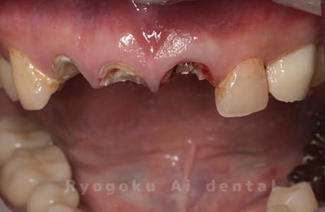前歯部補綴除去後