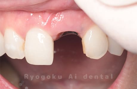 前歯部重度カリエス